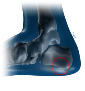 πόνος-στην-πτέρνα
