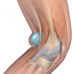 Η κύστη Baker είναι μια συνήθης κύστη πίσω στο γόνατο που εμφανίζεται ως διόγκωση του ορογόνου θυλάκου (bursa) μεταξύ ημιμεβρανώδους και γαστροκνημίου μυός στην έσω επιφάνεια του ιγνυακού βόθρου, λίγο πιο κάτω (περιφερικότερα) της κεντρικής πτυχής .Οι περισσότερες κύστεις δεν προκαλούν συμπτώματα ή επιπλοκές. Σημαντική βελτίωση έχουν 9 στους 10 περίπου ασθενείς με συμπτωματικές κύστεις που αντιμετωπίζονται με παρακέντηση και έγχυση γλυκορτικοειδούς υπό υπερηχογραφική καθοδήγηση σαν μοναδική θεραπεία.