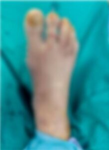 κότσι-χειρουργείο