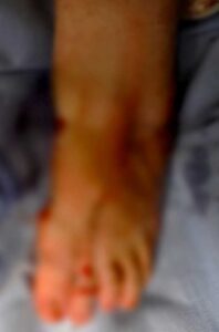 κότσι-βαριά-παραμόρφωση-χειρουργείο